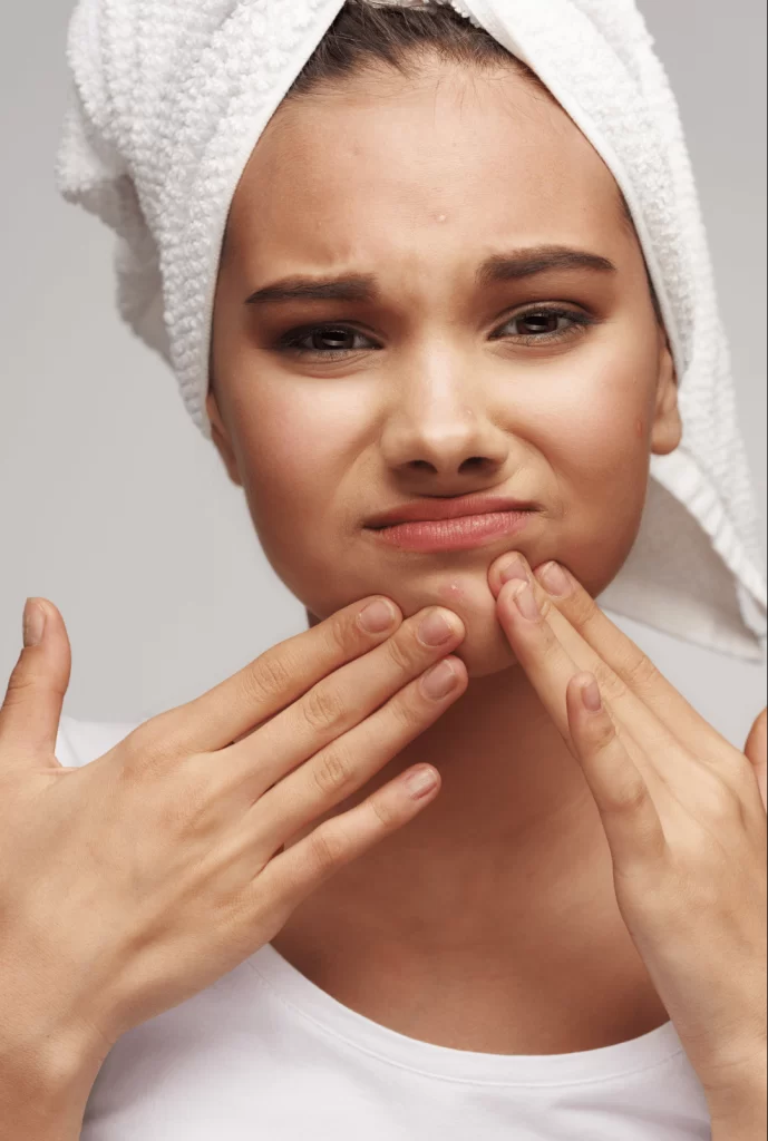 Acne treatments. Acne facial. acne scarring. acne scar removal.