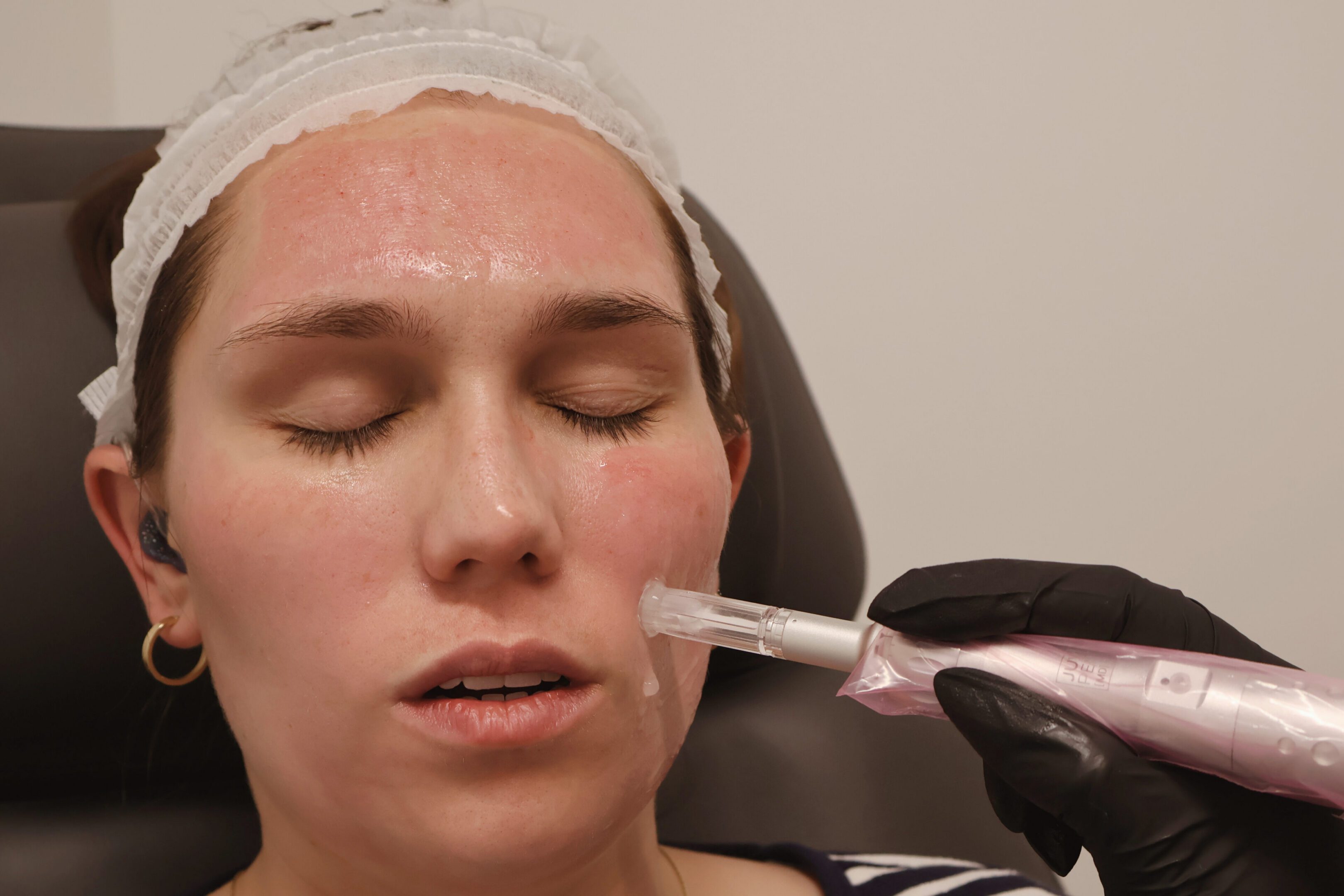 Microneedling treatment at SkynnGen Med Spa
