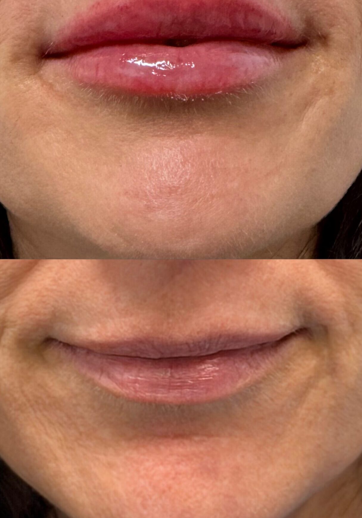 (1 Syringe of Lip Filler)