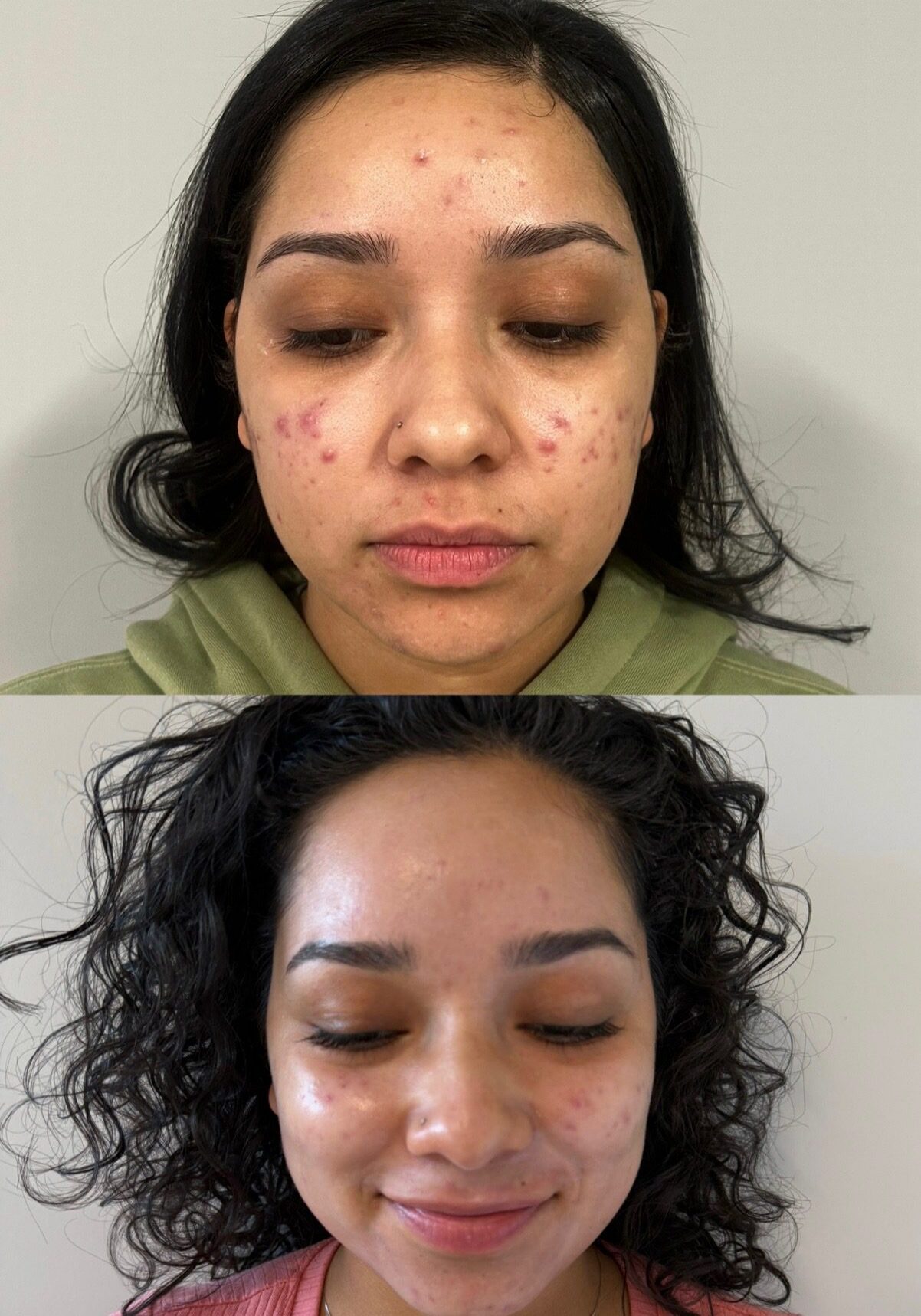 6 acne BBLs, 2 microneedling and Face Reality skin care 