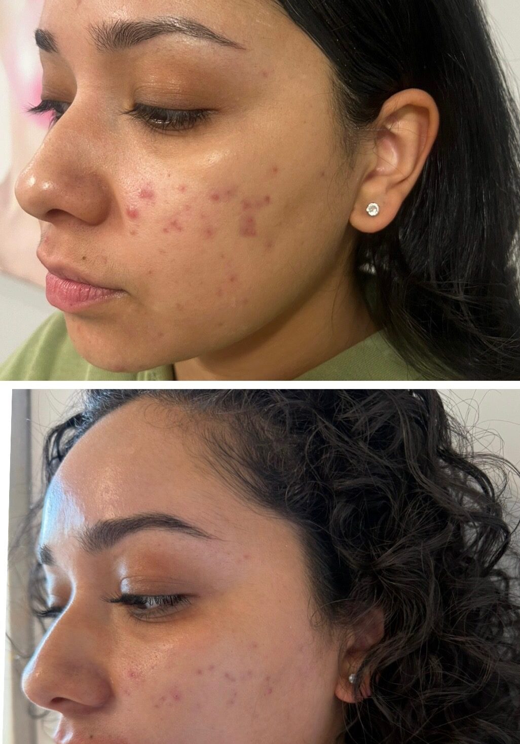 6 acne BBLs, 2 microneedling and Face Reality skin care 