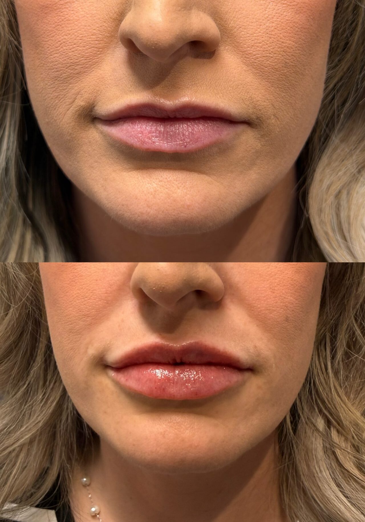 (0.6 mL of filler)