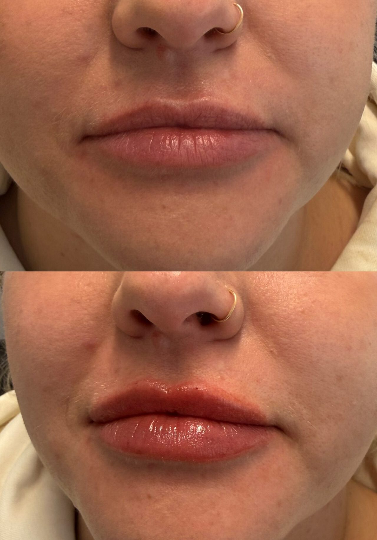 0.4 mL filler
Immediate Results