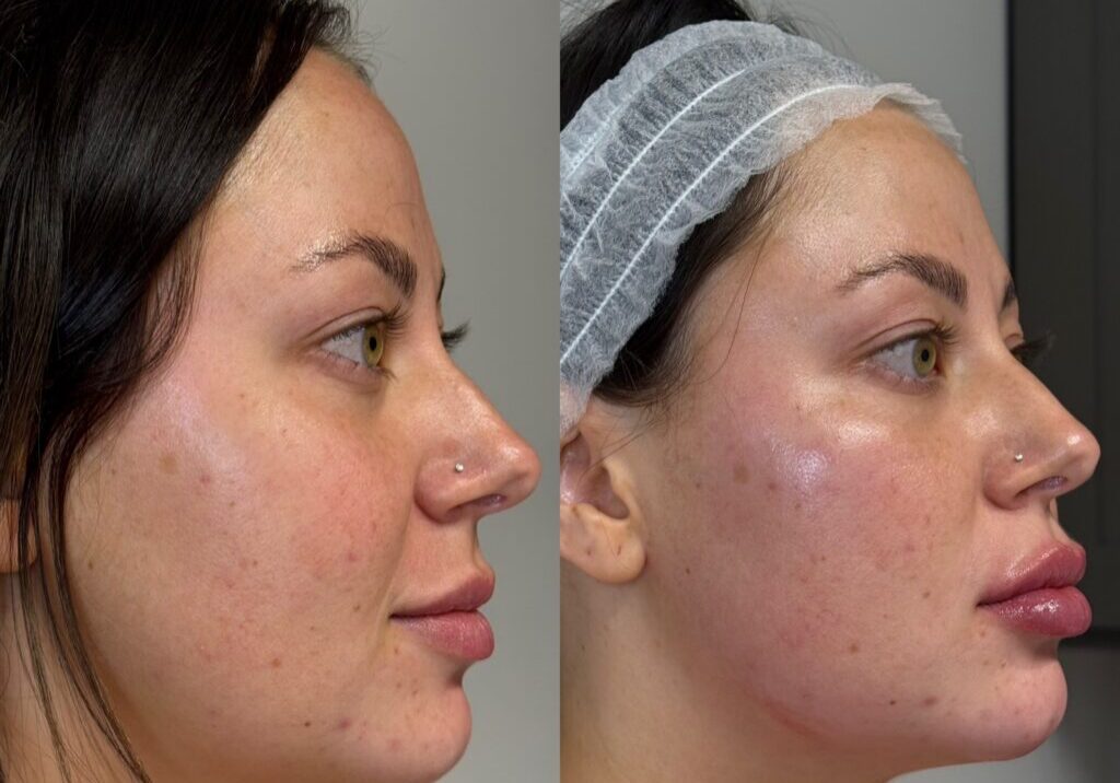 Before and after skincare treatment comparison