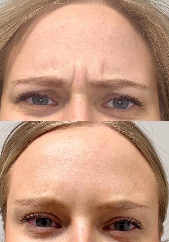 Facial wrinkle reduction comparison with Xeomin after 14 days