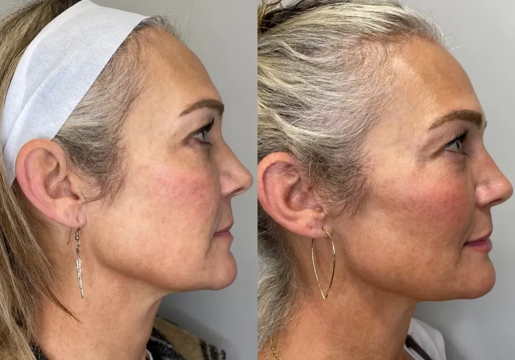 Before and after profile view of woman