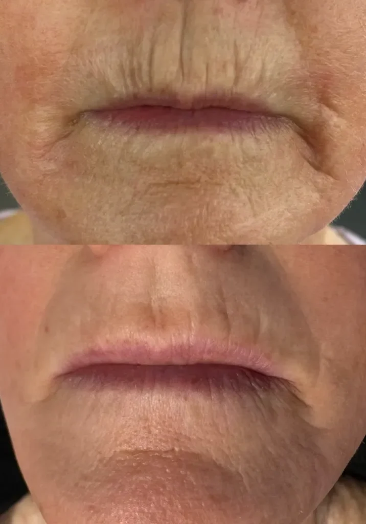 Anti-aging lip procedure before and after